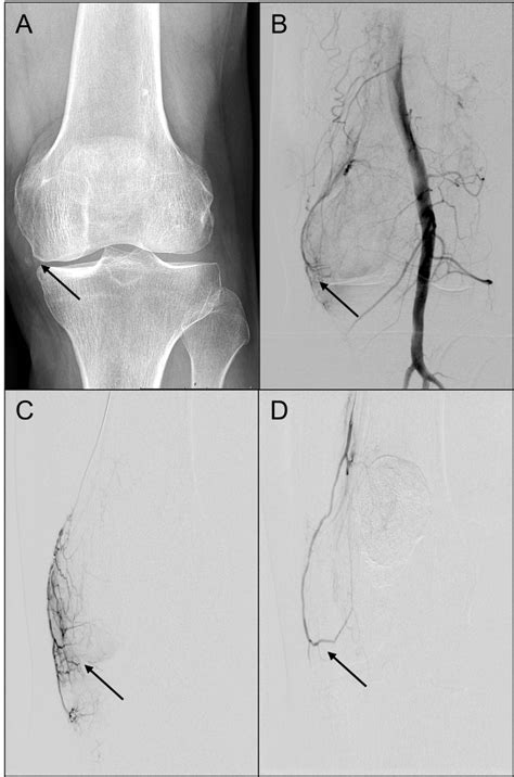 embolisation kniegelenk